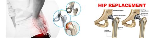 Recovery And Side Effects Of Hip Replacement Orthopedic Hospital