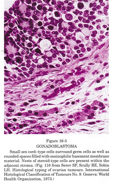 Pathology Outlines Gonadoblastoma