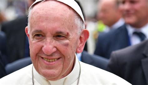 El Papa Francisco Se Ríe Del Golpazo Que Le Dejó El Ojo Morado En