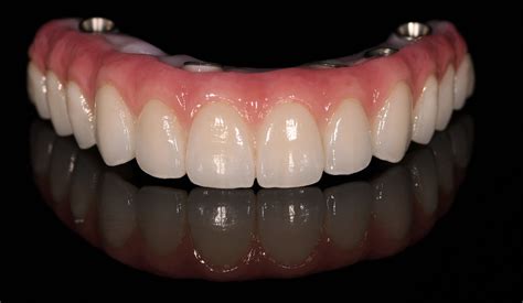 Dental Implants All On 4 All On 6 All On 8