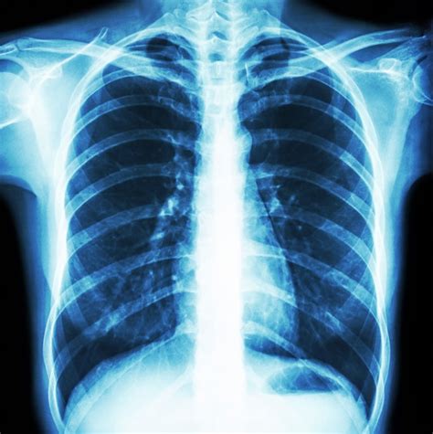 Radiografía De Tórax De Tórax Del Tórax Humano Normal Vista Frontal
