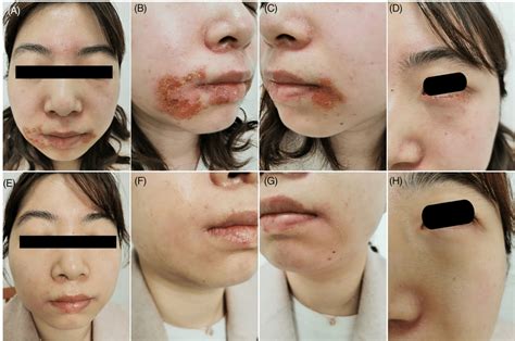 Clinical Images Skin Lesions Of The Patient With Goggle‐mask‐related