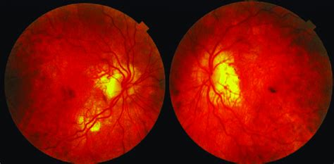 Color Fundus Photographs Demonstrating Pigment Deposits Around The