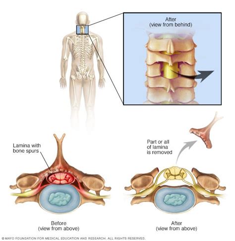 Laminectomy Procedure Preparation And Recovery Neuroaxis