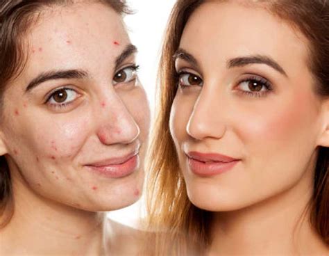 Acne Treatment Acne Scarring Clinic 33