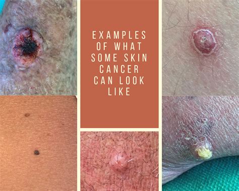 Examples Of What Some Skin Cancer Can Look Like Appalachian Spring Dermatology