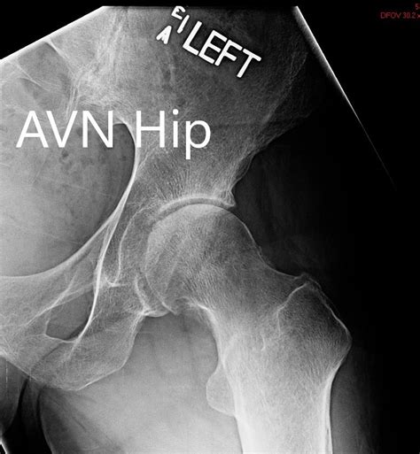 Case Study Robotic Left Hip Total Replacement For Arthritis