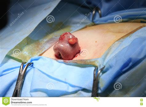General, art, business, computing, medicine, miscellaneous, religion, science, slang, sports, tech, phrases. Loop From Intestine Out Of Body Stock Photo - Image of ...