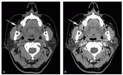 Imaging Of Head And Neck Cancer Oncohema Key