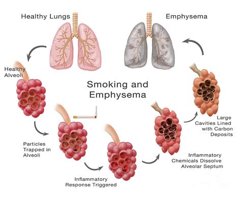 4 Stages Of Emphysema