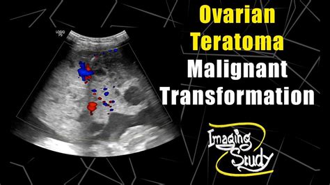 Ovarian Immature Teratoma Ultrasound Doppler Case Youtube