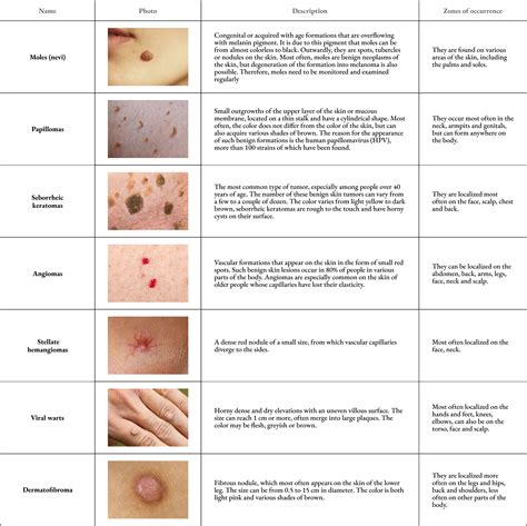 Types Of Benign Skin Neoplasms