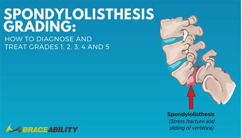 Spondylolysis Of The Lumbar Spine Symptoms Causes Treatments Images