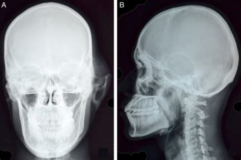 A Skull Pa View Reveals Swelling Of Osseus Origin Overlying Left