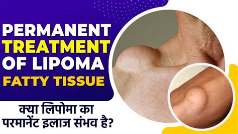 Permanent Treatment Of Lipoma Multiple Lipoma Solution Lipoma