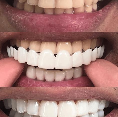 What Are Clip On Veneers News Dentagama Perfect Teeth Braces