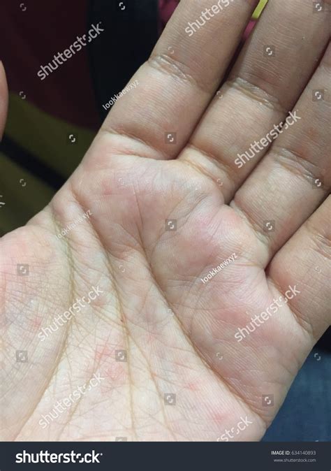 Urticaria On Hand Rash On Hand Stock Photo 634140893 Shutterstock