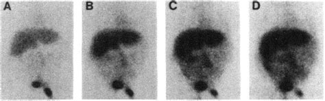 Technetium 99m Hida Scan Images In The Anterior Projection A 20 Min