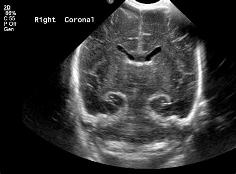 Periventricular Leukomalacia Pvl Image