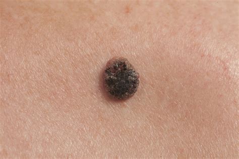 Skin Cancer Symptoms That You Shouldnt Ignore University Health News