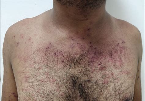 A Challenging Case Of Kikuchi Fujimoto Disease With Systemic Lupus