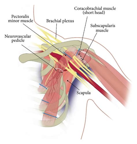 Use Of The Composite Pedicled Pectoralis Minor Flap After Resection Of