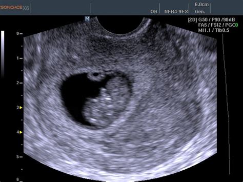 Ultrasound Images Fetus 8 Weeks B Mode Echogramm №458