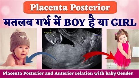 Placenta Posterior Means Boy Or Girl Placenta Anterior Means Boy Or