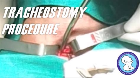 Tracheostomy Procedure The First Performed By The General Surgery
