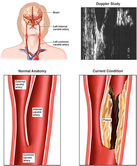 Carotid Artery Stenosis Chart My XXX Hot Girl