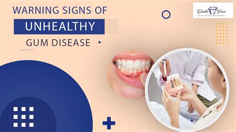 Warning Signs Of Unhealthy Gum Disease Dentaverse