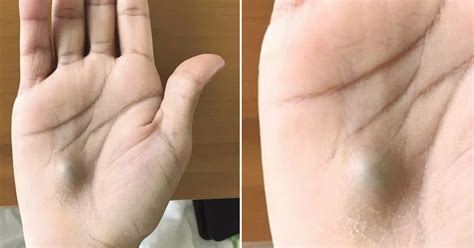 Canadian Man Finds Bump On His Hand After Visiting A Dentist Health Sumo
