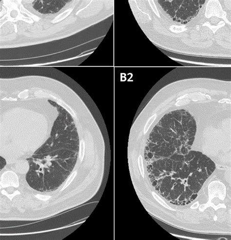 Chest High Resolution Computed Tomography Images Of Patients 1 A At