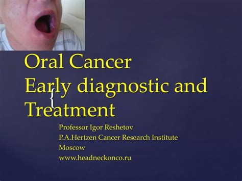 Ppt Oral Cancer Early Diagnostic And Treatment Powerpoint
