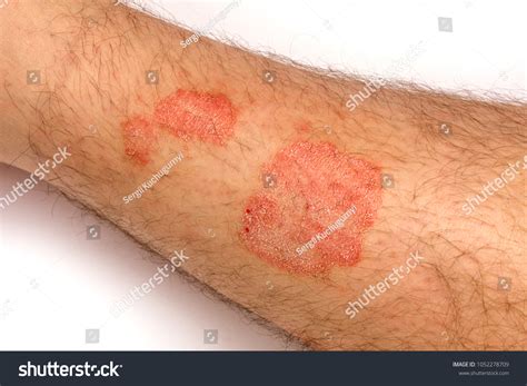 Psoriasis Skin Closeup Rash Scaling On Stock Photo 1052278709
