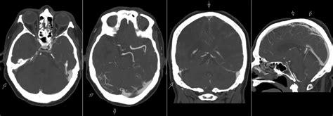 Radiology Mri Cerebral Venous Sinus Thrombosis