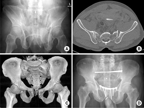 Pelvic Fracture Patterns