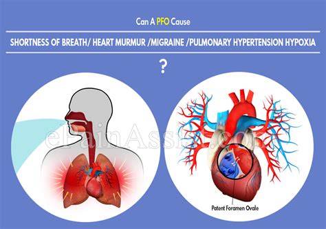 Can A Pfo Cause Shortness Of Breath Heart Murmur Migraine Pulmonary