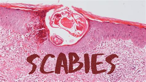 Scabies Pathology Mini Tutorial Youtube