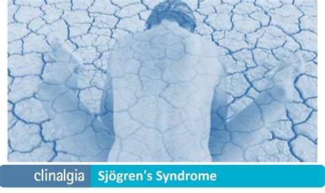 Sjögrens Syndrome Symptoms And Treatment Symptoms And Treatment
