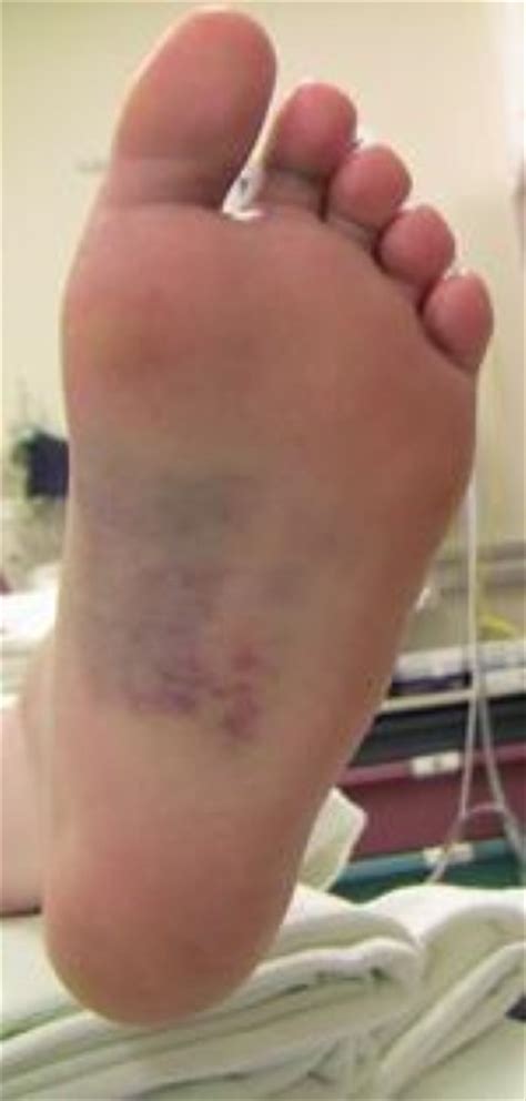 Lisfranc Midfoot Injury Orthoinfo Aaos