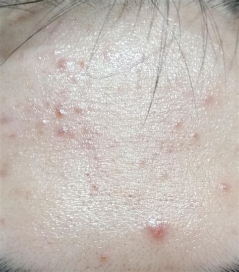 Skin Concern Are They An Allergic Reaction Causing A Outbreak R
