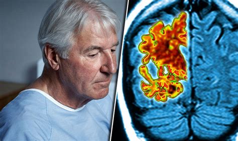 Dementia is an abnormal, serious loss of cognitive. Dementia treatment could slow down effects of disease ...