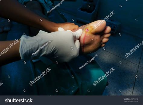 Abscess At Left Foot Infected Wound Patient On The Bed In Ope Stock