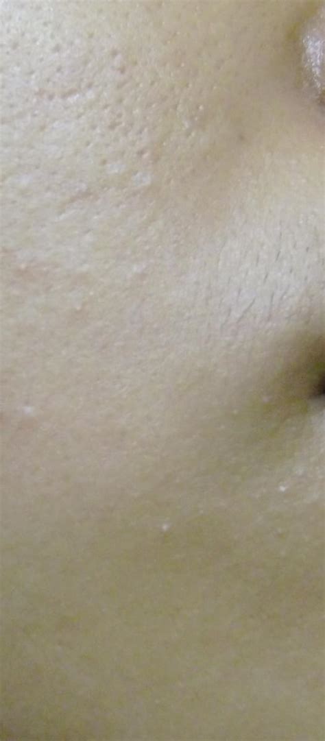 Tiny Little Whiteheads Like Bumps Which Have Redinflamed Bases Cause