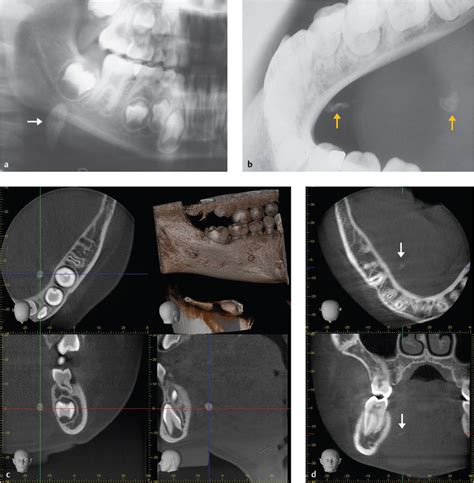 11 Pediatric Endoscopic Salivary Gland Surgery Ento Key