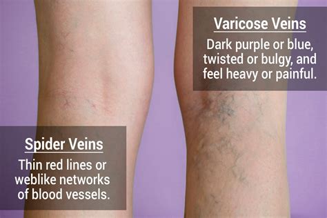Varicose Vein Treatment Center For Advanced Cardiac And Vascular
