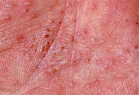 Eczema Close Up Of Patients Palm Stock Image M1500068 Science