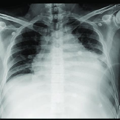Chest Radiography Showed Cardiomegaly And Left Pleural Effusion