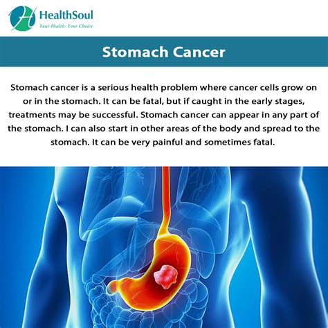 Stomach Cancer Healthsoul
